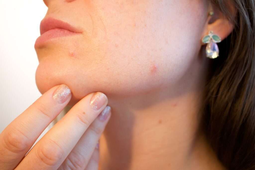 How to get rid of pimple scars